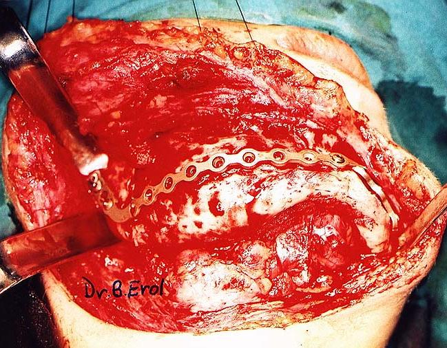 Ameloblastomanın preoperatif radyografik görünümleri. postoperatif fonksiyon ve fasiyal estetik sağlanmış oldu (Resim 7,8).