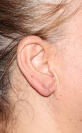 amaçlı kulak cerrahisi operasyonu geçirmektedir. Estetik kulak girişimleri erkeklerde altıncı sırada, kadınlarda ise 14. sırada en sık yapılan cerrahi uygulamadır.