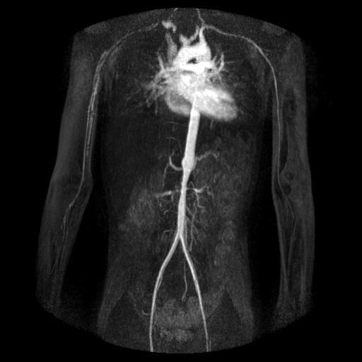MR Anjiografi Abdominal aorta proksimal kesimde orta derecede darlık lehine kalibrasyonda azalma, darlık proksimalinde abdominal aortada kısa segment
