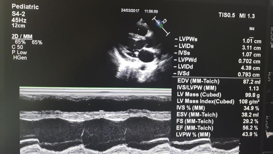 Ekokardiografi Yaş: 9 Cinsiyet: Kız İSTİNYE ÜNİVERSİTESİ LİV HASTANESİ ÇOCUK KARDİYOLOJİSİ EKOKARDİYOGRAFİ RAPORU EF ( 56 %) RVP (tahmini S/D- 32 mmhg) KF ( 29 %) Kalp boşlukları: Septum ve arka
