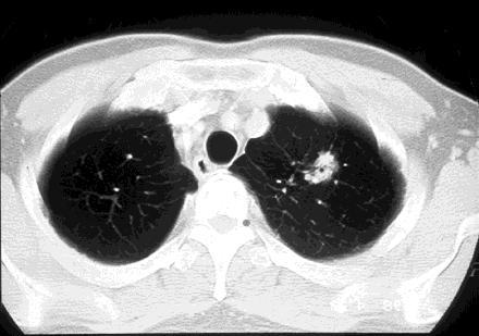 Soliter pulmoner nodül 150.