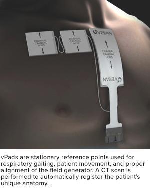 Navigasyonlu TTİAB Electromagnetic Navigational Transthoracic Needle