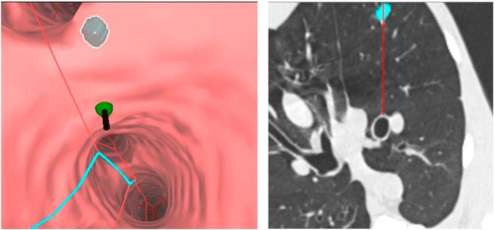 Archimedes Virtual Bronchoscopy Navigation (VBN) System (Broncus USA) Transparankimal tünel ile nodül biyopsisi. A.