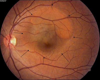 Şekil 1: Santral Seröz Koriyoretinopatili hastada renkli fundus fotoğrafında sensöriyel retinada elevasyon alanı Şekil 2: Santral Seröz Koriyoretinopatili hastada OCT incelemesinde (optik kohorens