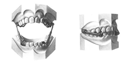 Şekil 1.14 Apareyin orijinal şeklinin ağızda görünümü. Bant ve kronlar, dayanıklı dişlere uygulanmakta, materyal olarak Alman gümüşü veya altın kullanılmaktaydı.