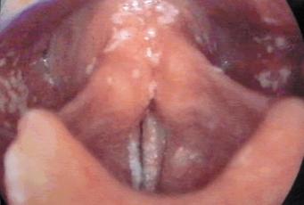 nhale Kortikosteroid Kullan m na Ba l Larengeal Kandidiyazis Resim 4. Kord vokaller üzerindeki tipik kandidiyal lezyonlar (addüksiyon).