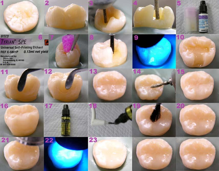 Resim 1. Glaze uygulaması Bazı etanol içerikli glaze materyallerinin uygulanması esnasında polimerizasyon öncesi 15-20 sn beklemek gerekmektedir.