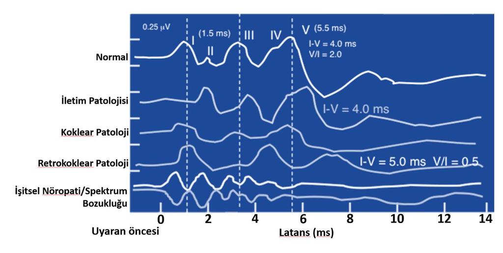 Şekil 2.14. ABR dalga formu analizi parametreleri Şekil 2.15. Patolojiye bağlı ABR dalga morfolojisi ve latans değişimleri 2.6.1. ABR eşiklerinin davranışsal eşiklerle ilişkisi Davranışsal eşikleri tahmin etmek için son adımda, fizyolojik (ABR) eşiklerini davranışsal saf ton eşikleriyle ilişkilendirmek gerekmektedir.