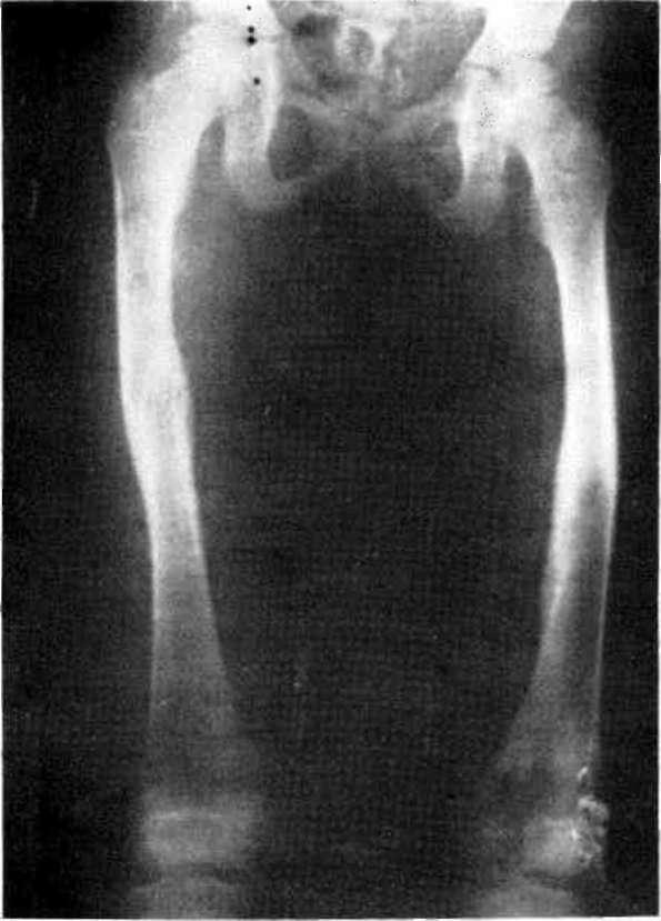 Çocuk Femur Diafiz Kırıklarının Konservatif Tedavisi/ULUDAĞ, GÜNEL, BÎÇİMOĞLU, YETKİN femur diafiz kırığından 309'una konservatif tedavi, ll'ine ise cerrahi tedavi yöntemleri uygulandı.