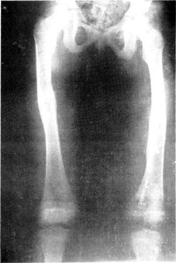 Çocuk Femur Diafiz Kırıklarının Konservatif Tedavisi/ULUDAĞ, GÜNEL, BİÇİMOĞLU, YETKİN Çocuk femur diafiz kırığı olarak 0-14 yaş grubu arasındaki olguları değerlendirdik (Ortalama 6.95 yaş).