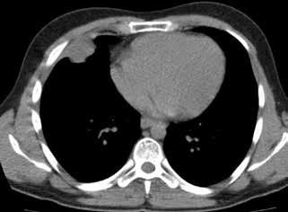 Atelektazi Atelektazi, endobronşiyal hastalık gibi intrensek veya lenf bezi basısına bağlı ekstrensek olarak gelişmektedir.