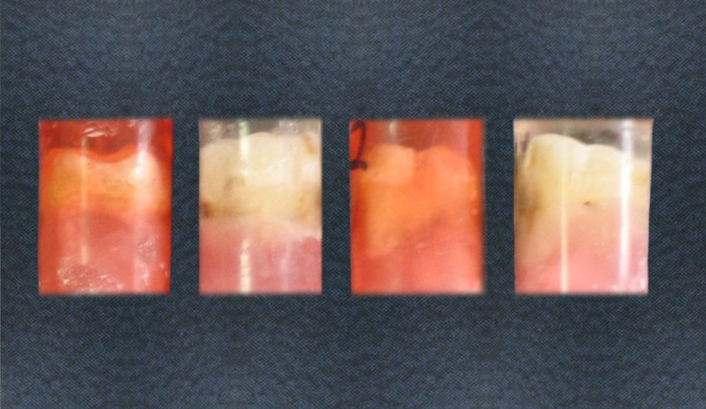 69 Şekil 10. Şeffaf ortodontik akrilik rezine gömülen daimi dişlerden örnekler Şekil 11.