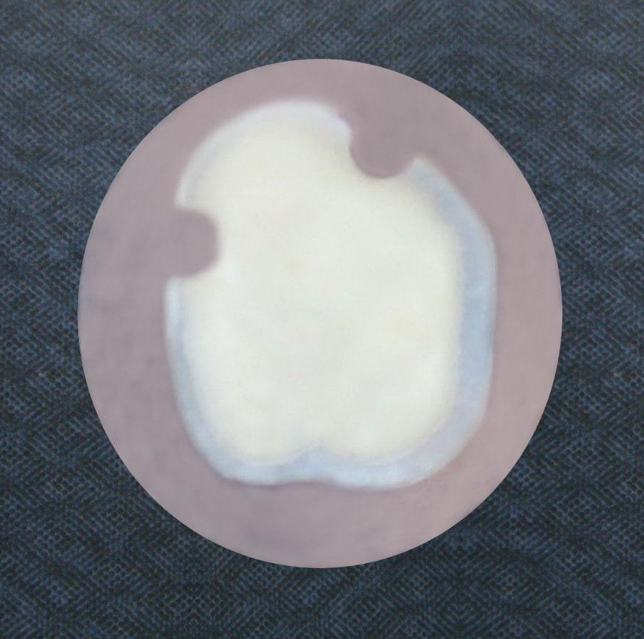 71 Şekil 13. Pleksiglas halkaya yapıştırılmış süt dişi dentini kesitinin ön (pulpal) ve arka (okluzal) yüz görünümü 3-1.2.