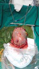 Şekil 5: Frontal ve oksipital subperiostal diseksiyon sonrası cilt fleblerinin devrilmiş görünümü.