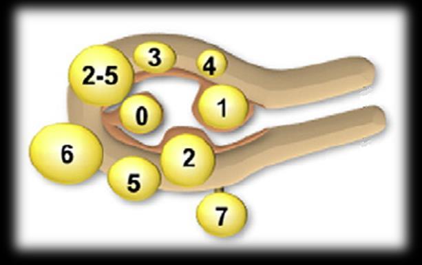 Leiomyomlar (AUB-L) SM-SubMüköz 0 Pedinküllü intrakaviter 1 <50% intramural 2 50% intramural O-Other 3 Endometriyuma kadar