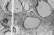 Orta kulak mukozas nda psödostratifiye epiteldeki skuamöz metaplazi ile birlikte, subepitelyal infiltrasyon, inflamatuar hücreler tesbit edildi.