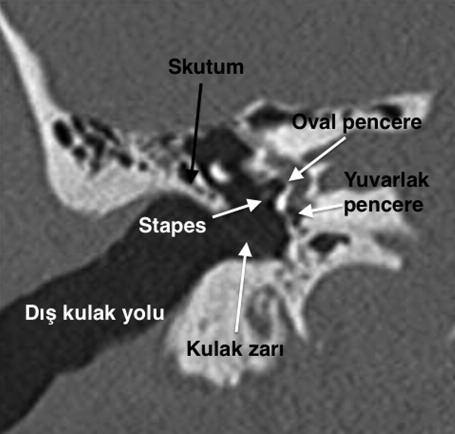 10 Malleus ve inkus korpuslarının değerlendirilmesinde doğruluk oranı %83 tür. 3 O Donoughe, inkusun uzun kolundaki erozyonu ve stapes suprastrüktüründeki erozyonu %67 olarak doğru saptamıştır.