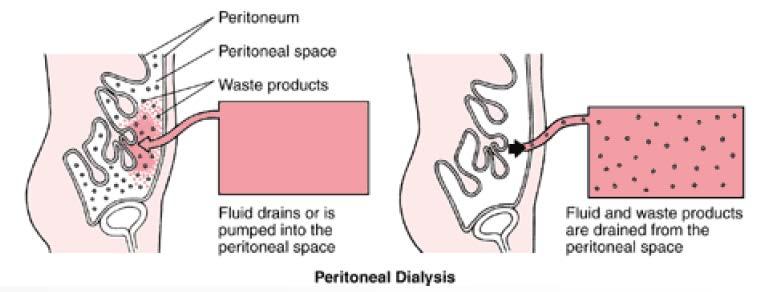 Extrakorporeal Tedaviler Periton Diyalizi Hemodiyalize göre etkinliği