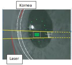 Şekil 3.Flare ölçüm görünümü Şekil 4. Laser flaremetre grafik ve liste ölçüm sonucu 2.4.3. Laser flaremetre ölçümünü etkileyen faktörler 2.4.3.1.