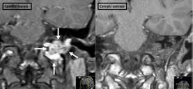 (C) Post-embolizasyon aksiyal ve koronal planda kemik pencerede elde edilmiş bilgisayarlı tomografi kesitlerinde tümörün vasküler yatağını dolduran içinde EVOH kütlesi izlenmektedir.