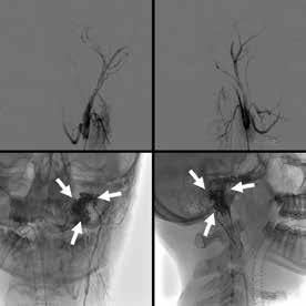 D GLOMUS JUGULARE Juguler bulbusun adventisiya tabakasındaki nöral krista kökenli glomus cisimsiklerinden kaynaklanan nöro-endokrin tümörlerdir. Hastalar IX. X veya XI.