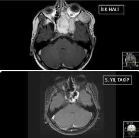 Baş-Boyun Tümörlerinde Pre-operatif Embolizasyon 105 A B C vinil alkol kopolimer=evoh) kullanılmaya başlanmıştır.