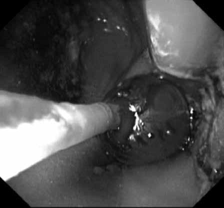 As m Cingi ve ark. fiekil 2. Anastomoz hatt n n endoskop kullan larak balon dilatasyonu Çal flmaya al nan hastalarda cerrahi alan enfeksiyonu tespit edilmemifltir.