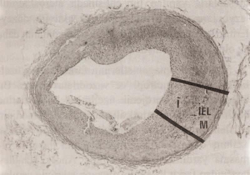 işaretlenmiş bölgedeki intimal hiperplazinin büyük büyütme görünümü (Verhoeff'un elastin boyası x 200) (1- B). (Đ: Đntima, M: Media, ĐEL: Đnternal Elastik Lamina) Resim 2.
