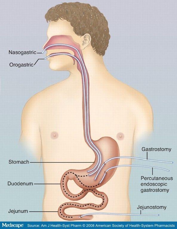 TÜPLE BESLENME Orogastrik Nazogastrik