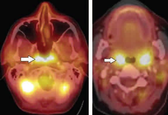 Nazofarengeal alanda bilateral yoğun fizyolojik adenoid uptake.