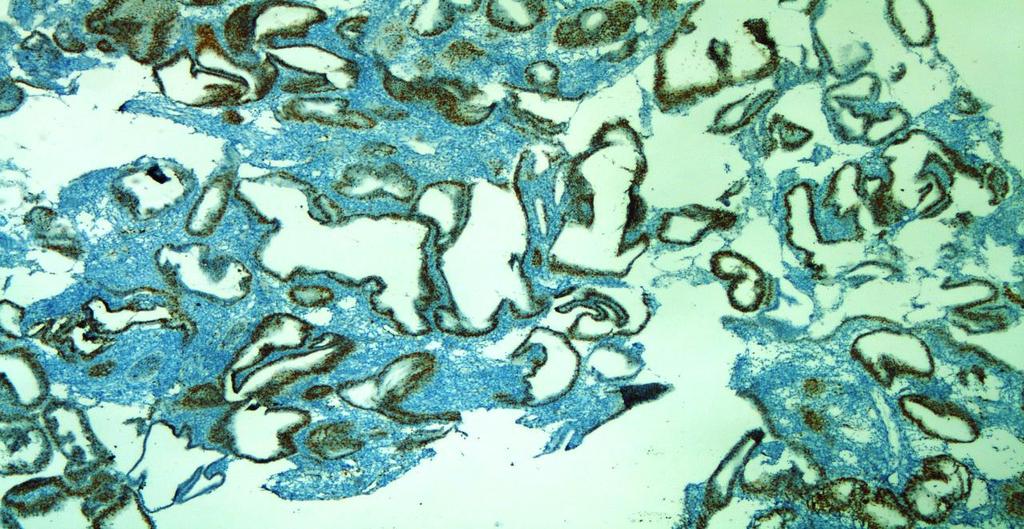 Siklin D1: On adet proliferatif endometriyum vakasından 2 tanesi (%20) (+); 7 tanesi (%70) (++); 1 tanesi (%10) (+++) saptanmıştır.