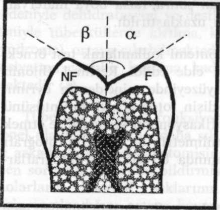 (A : Fonksiyonel tüberkül genişliği, B: Fonksiyonel olmayan tüberkül genişliği, F : Fonksiyonel tüberkül, N : Fonksiyonel olmayan tüberkül). 2.