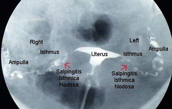 18 Şekil 2.3. HSG görüntüsü Laparoskopi Tubal ve peritoneal hastalıkların tanısında altın standart laparoskopidir (16,17,20).