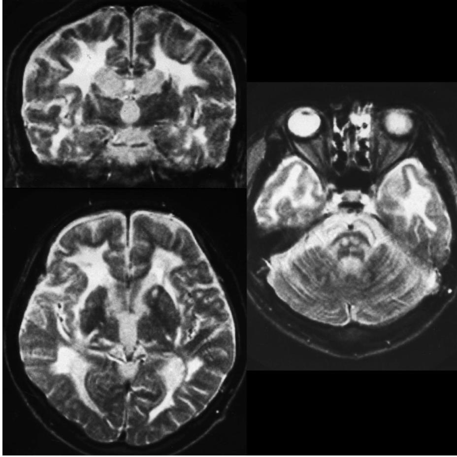 CARASIL (serebral otozomal resesif arteriyopati, subkortikal infarktlar ve lökoansefalopati) HRTA1 gen mutasyonu, TGF