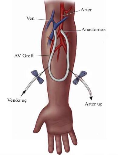 (AVF) Arteriovenöz greft