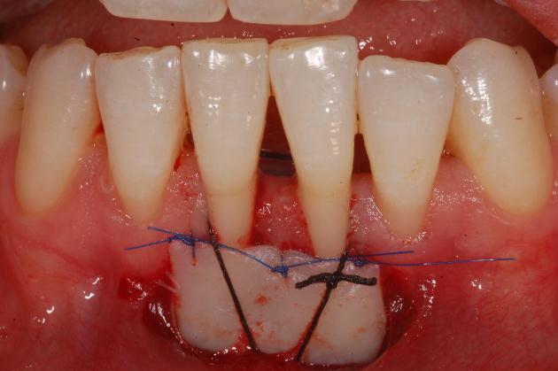 31 3.4.2.3. Greftlerin alıcı bölgeye yerleştirilmesi Alınan greftler, ilgili dişin diş eti kenarını oluşturacak ve greftin bağ dokusu yüzeyi alıcı bölgeyle bire bir temas edecek şekilde yerleştirildi.
