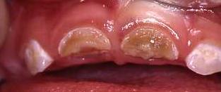 Diş Çürüğü Diş çürüğü her yaşta görülebilen bir bakteri enfeksiyonudur.