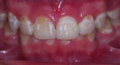 Diş Çürüğü Oluşumu Dişlerde çürük oluşması için, Çürük yapıcı bakteriler Fermente olabilen karbonhidratlar Çürüğe duyarlı diş