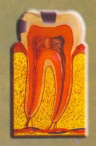 Diş; gümüş rengi amalgam dolgu ile ya da diş renginde kompozit dolgu ile restore