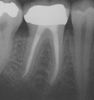 Kanal Tedavisi sağlıklı diş başlangıç çürüğü diş kökünde pü oluşumu dolgu eğe