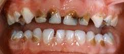 İlkokul Çağı Çocuklarında Diş Çürüğü İlkokul ve daha erken çocukluk döneminde, diş çürükleri hızla ilerler ve dişte yaygın madde kaybına yol açar.