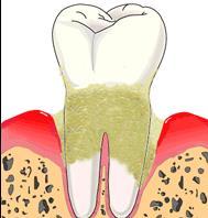 Klinik olarak ataşman (bağ dokusu) kaybı ve radyografik olarak alveol kemiğinde erime görülüyorsa periodontitis