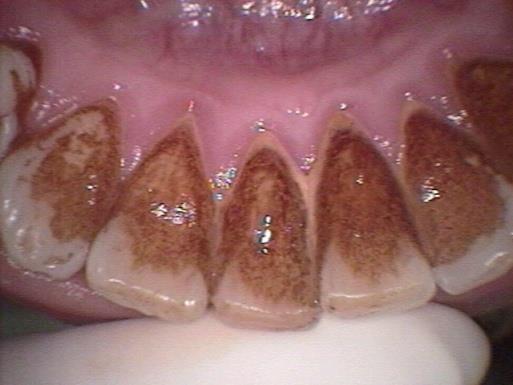 Dişeti Hastalıklarının Tedavisi Önce Sonra Dişeti hastalıkları periodontal