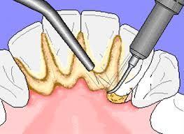 Periodontal tedavinin en önemli aşamaları periodontal başlangıç tedavisidir;