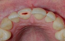 Ağız ve Diş Yaralanmalarında Yapılması Gerekenler Diş Kırılması Durumunda,