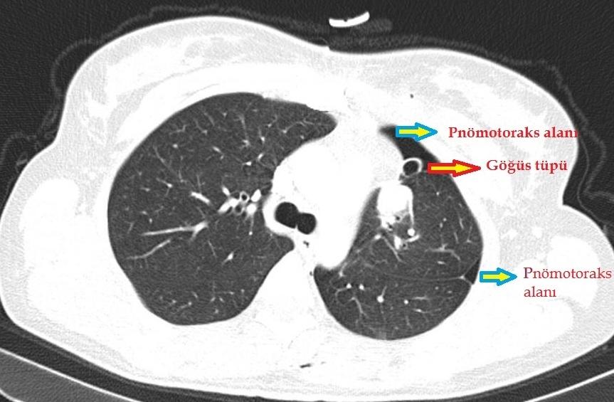 parankimden kaynaklı hemoptizi gelişmesi durumlarında cerrahi girişim gerekebilir 2.