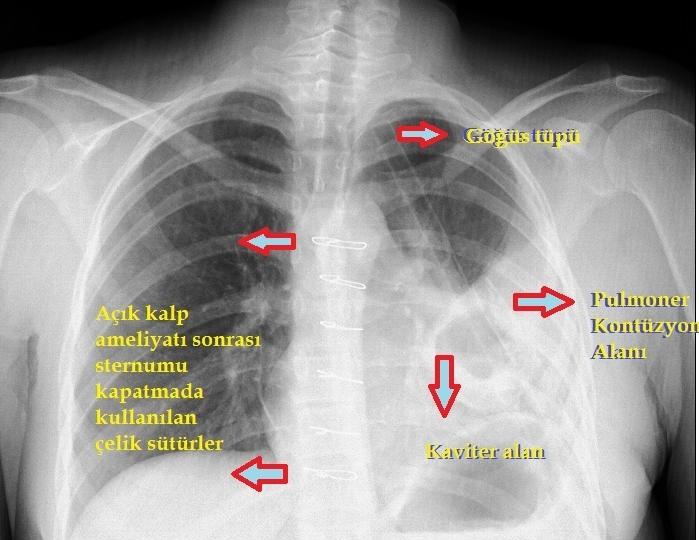 Şekil 3 : Sol akciğerdeki pulmoner kontüzyon alanı içerisinde kaviter lezyon imajı