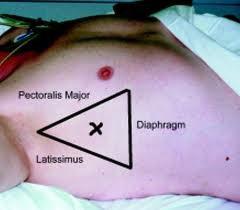 interkostal aralığa kadar uzanan bölge bu iş için