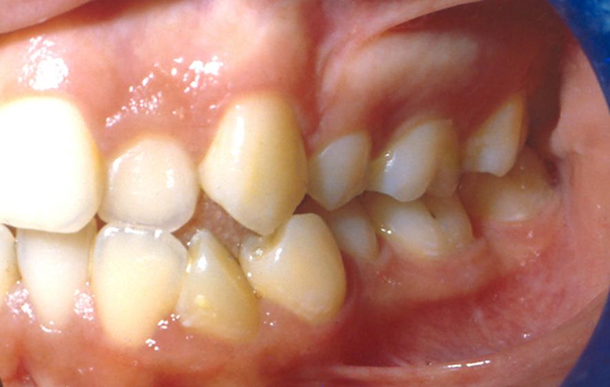 kaybettiği üst sağ santral diş bölgesinde özellikle lateral yönde yetersiz alveoler yapı tespit edilmiştir.