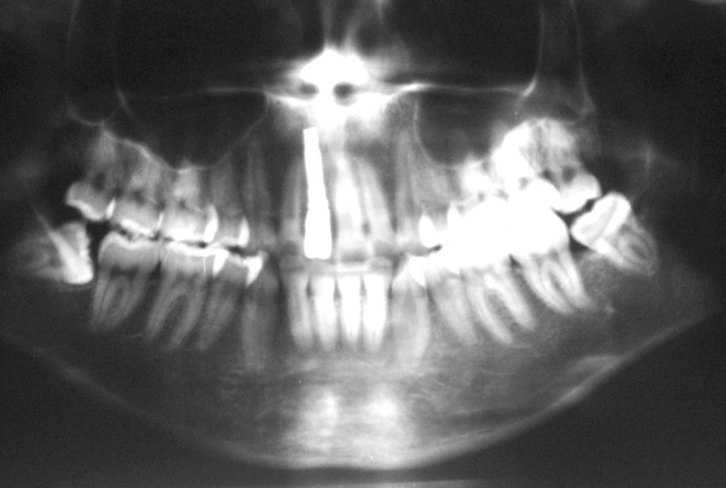 Anterior diş kayıplarında tedavi alternatiflerinden biri, eksik dişin yerinin ortodontik tedavi ile açılması ve hasta 18 yaşına gelene kadar bu yerin dişli yer tutucular ile korunması, ileri dönemde